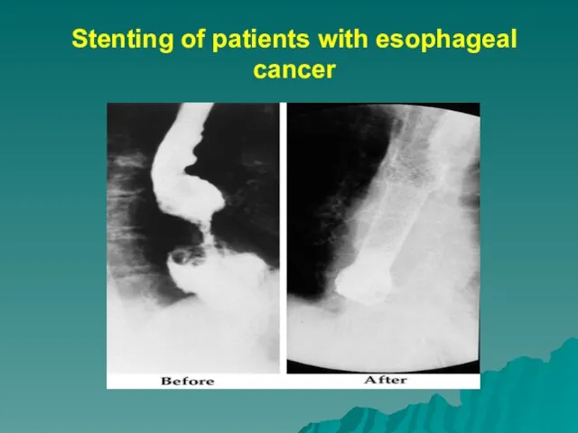 Stenting of patients with esophageal cancer