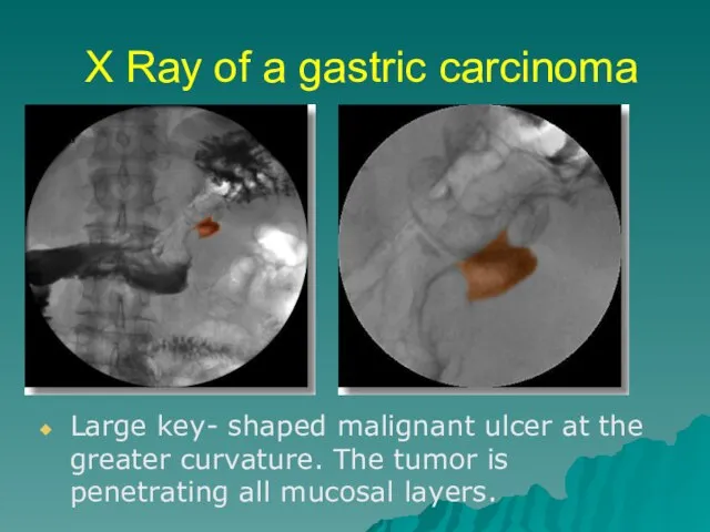 X Ray of a gastric carcinoma Large key- shaped malignant ulcer