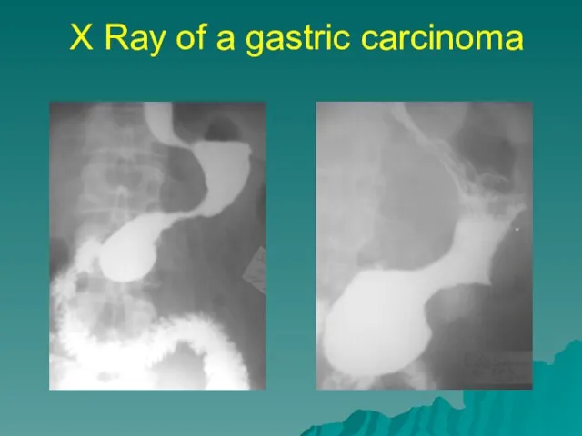 X Ray of a gastric carcinoma