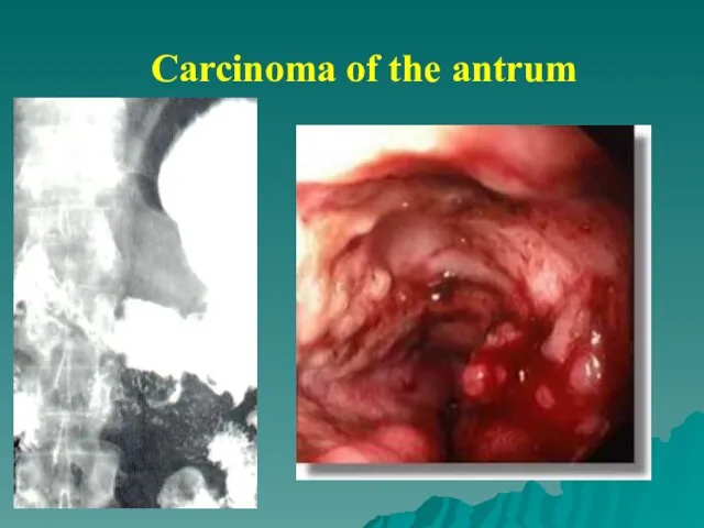 Carcinoma of the antrum