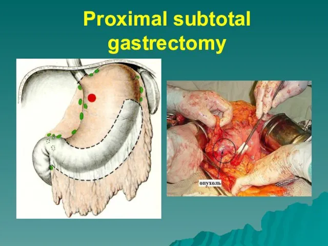 Proximal subtotal gastrectomy