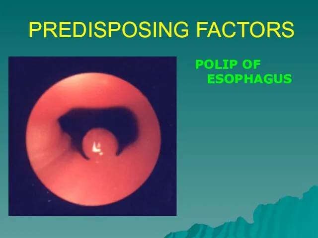 PREDISPOSING FACTORS POLIP OF ESOPHAGUS