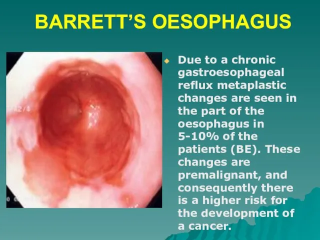 BARRETT’S OESOPHAGUS Due to a chronic gastroesophageal reflux metaplastic changes are