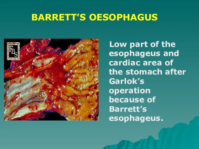 Low part of the esophageus and cardiac area of the stomach