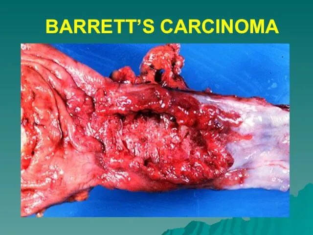 BARRETT’S CARCINOMA