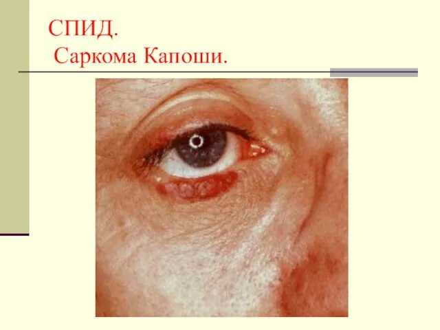 СПИД. Саркома Капоши.