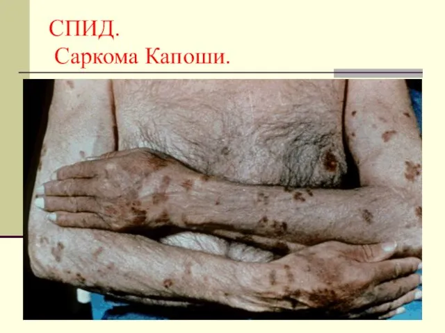 СПИД. Саркома Капоши.