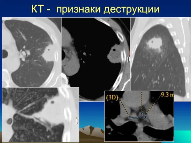 КТ - признаки деструкции