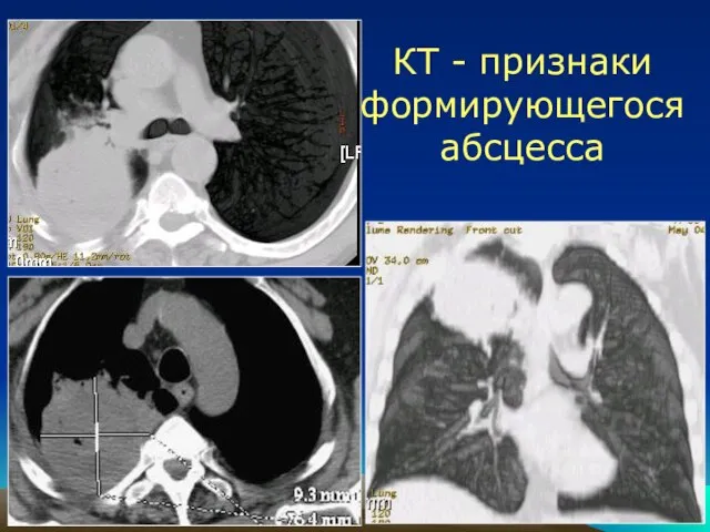 КТ - признаки формирующегося абсцесса