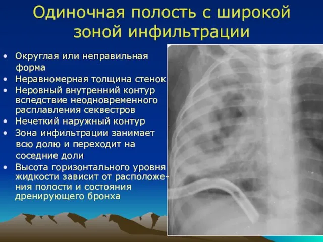 Одиночная полость с широкой зоной инфильтрации Округлая или неправильная форма Неравномерная