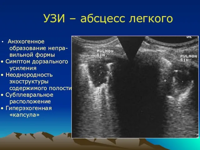 УЗИ – абсцесс легкого Анэхогенное образование непра- вильной формы Симптом дорзального