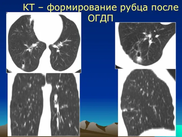 КТ – формирование рубца после ОГДП