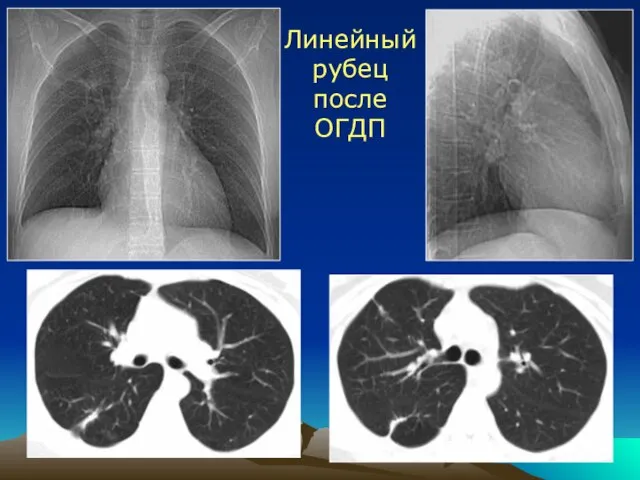 Линейный рубец после ОГДП