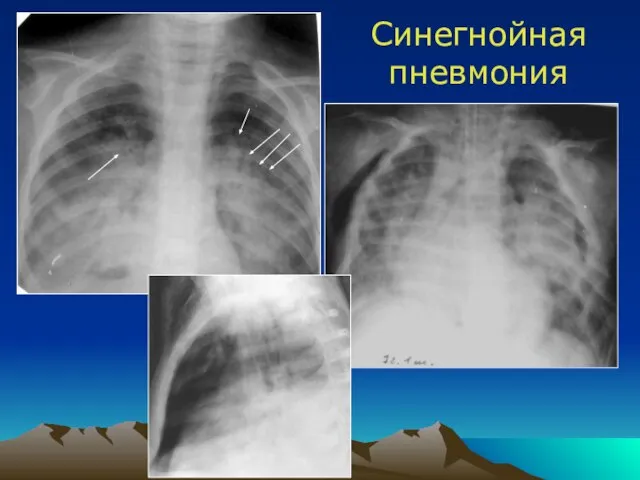 Синегнойная пневмония