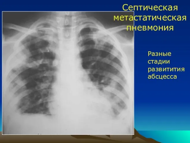 Септическая метастатическая пневмония Разные стадии развитития абсцесса