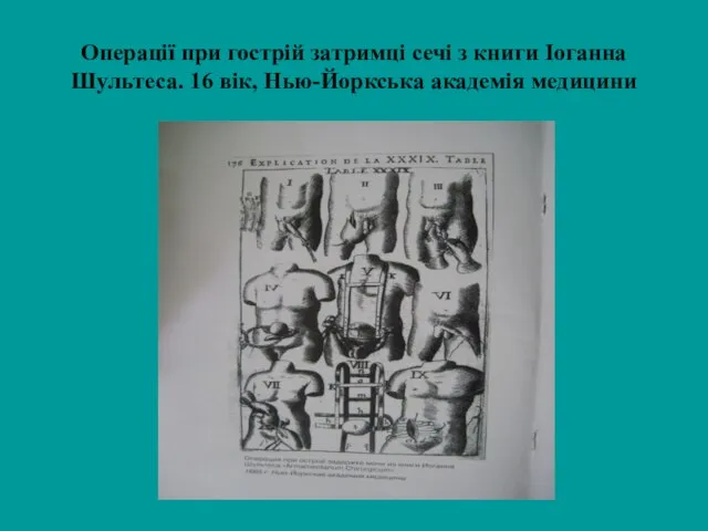 Операції при гострій затримці сечі з книги Іоганна Шультеса. 16 вік, Нью-Йоркська академія медицини