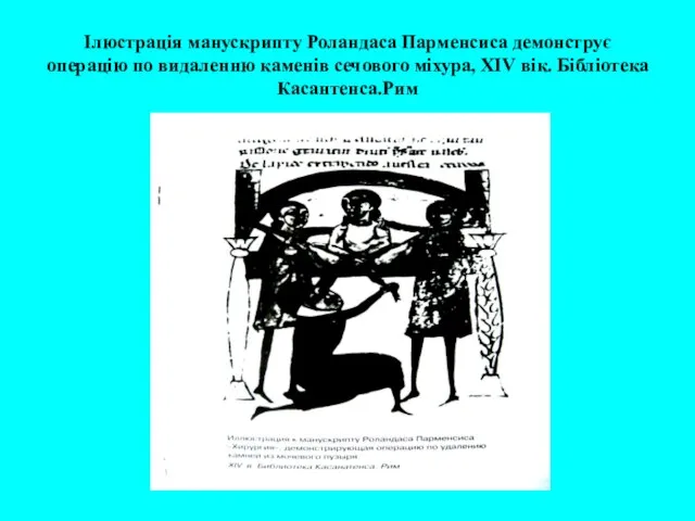 Ілюстрація манускрипту Роландаса Парменсиса демонструє операцію по видаленню каменів сечового міхура, ХIV вік. Бібліотека Касантенса.Рим