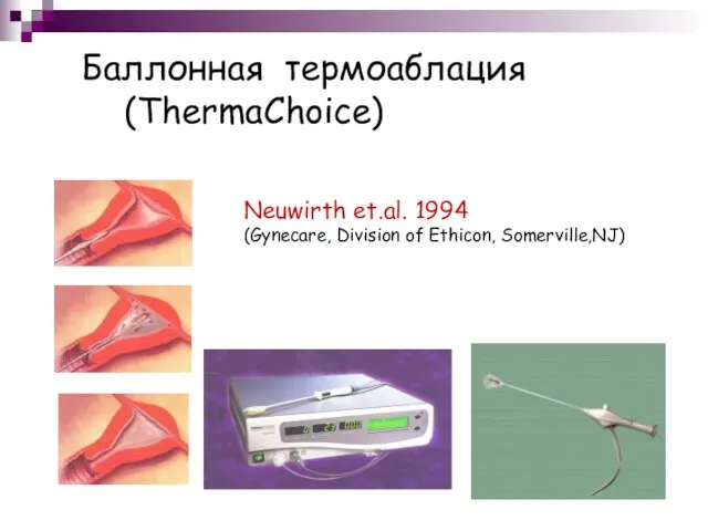 Баллонная термоаблация (ThermaChoice) Neuwirth et.al. 1994 (Gynecare, Division of Ethicon, Somerville,NJ)