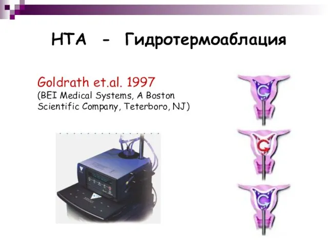 HTA - Гидротермоаблация Goldrath et.al. 1997 (BEI Medical Systems, A Boston Scientific Company, Teterboro, NJ)