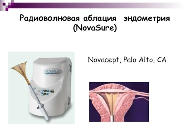 Радиоволновая аблация эндометрия (NovaSure) Novacept, Palo Alto, CA