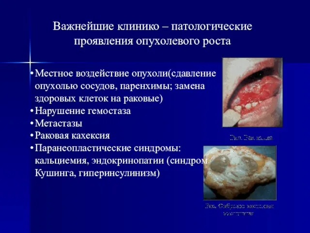 Важнейшие клинико – патологические проявления опухолевого роста Местное воздействие опухоли(сдавление опухолью