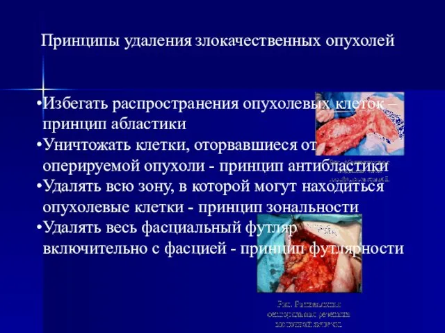 Принципы удаления злокачественных опухолей Избегать распространения опухолевых клеток – принцип абластики