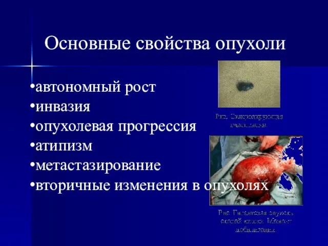 автономный рост инвазия опухолевая прогрессия атипизм метастазирование вторичные изменения в опухолях Основные свойства опухоли