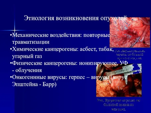 Этиология возникновения опухолей Механические воздействия: повторные травматизации Химические канцерогены: асбест, табак,