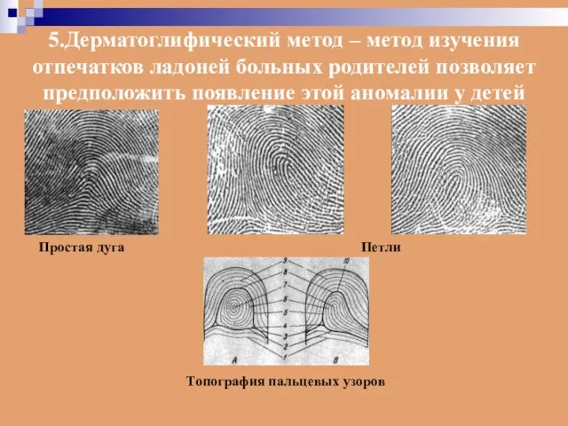 Простая дуга Петли Топография пальцевых узоров 5.Дерматоглифический метод – метод изучения