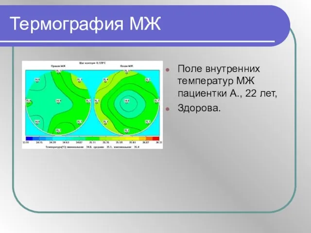 Термография МЖ Поле внутренних температур МЖ пациентки А., 22 лет, Здорова.