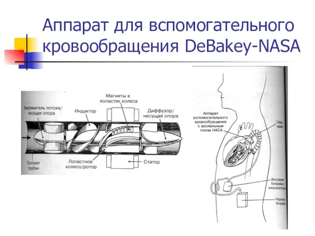 Аппарат для вспомогательного кровообращения DeBakey-NASA