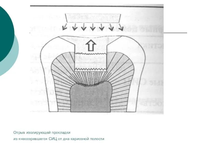 Отрыв изолирующей прокладки из «несозревшего» СИЦ от дна кариозной полости