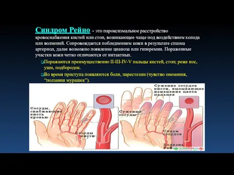 Синдром Рейно - это пароксизмальное расстройство кровоснабжения кистей или стоп, возникающее