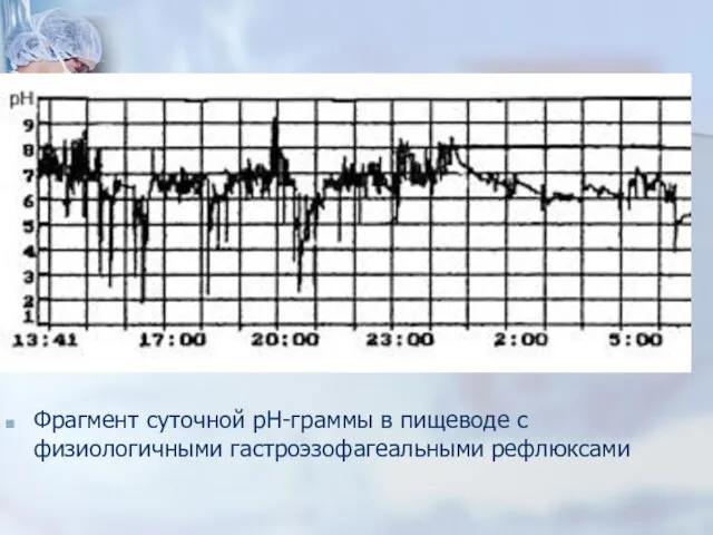 Фрагмент суточной рН-граммы в пищеводе с физиологичными гастроэзофагеальными рефлюксами