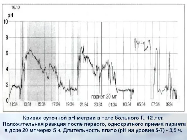 Кривая суточной рН-метрии в теле больного Г., 12 лет. Положительная реакция