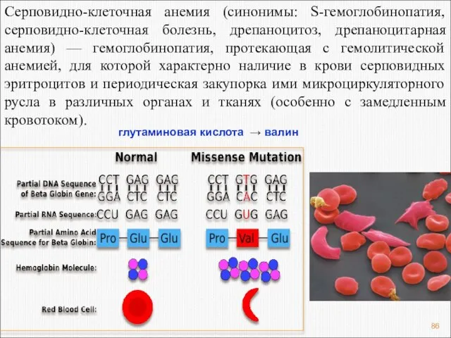 Серповидно-клеточная анемия (синонимы: S-гемоглобинопатия, серповидно-клеточная болезнь, дрепаноцитоз, дрепаноцитарная анемия) — гемоглобинопатия,