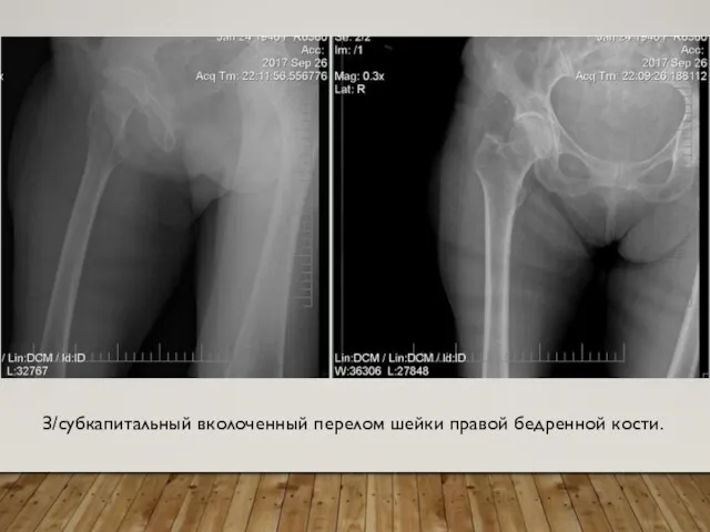 З/субкапитальный вколоченный перелом шейки правой бедренной кости.