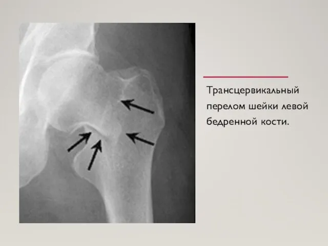 Трансцервикальный перелом шейки левой бедренной кости.