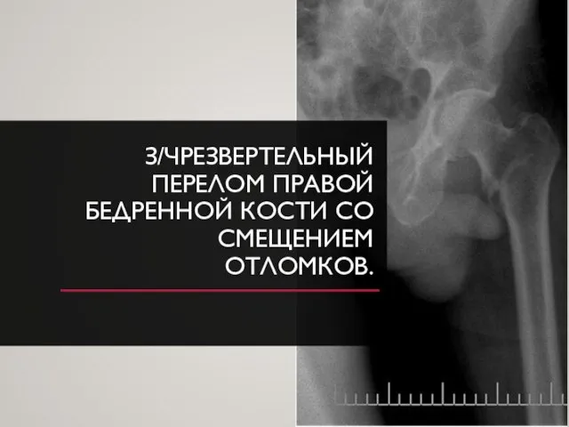 З/ЧРЕЗВЕРТЕЛЬНЫЙ ПЕРЕЛОМ ПРАВОЙ БЕДРЕННОЙ КОСТИ СО СМЕЩЕНИЕМ ОТЛОМКОВ.