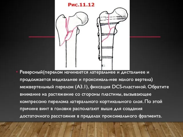 Реверсный(перелом начинается латеральнее и дистальнее и продолжается медиальнее и проксималь-нее малого