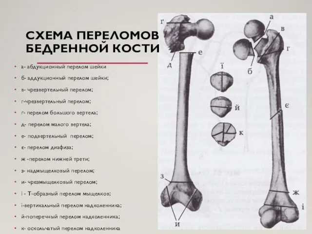 СХЕМА ПЕРЕЛОМОВ БЕДРЕННОЙ КОСТИ а- абдукционный перелом шейки б- аддукционный перелом