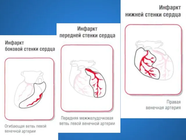 Формы инфаркта миокарда