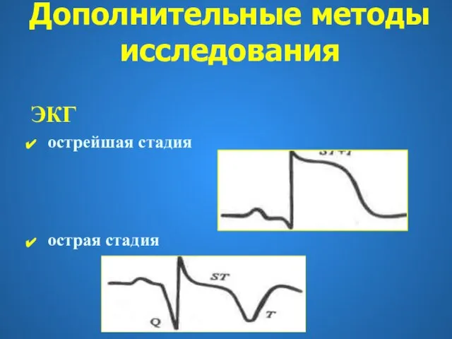 ЭКГ острейшая стадия острая стадия Дополнительные методы исследования