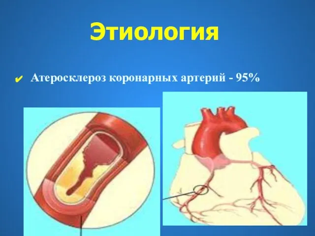 Этиология Атеросклероз коронарных артерий - 95%