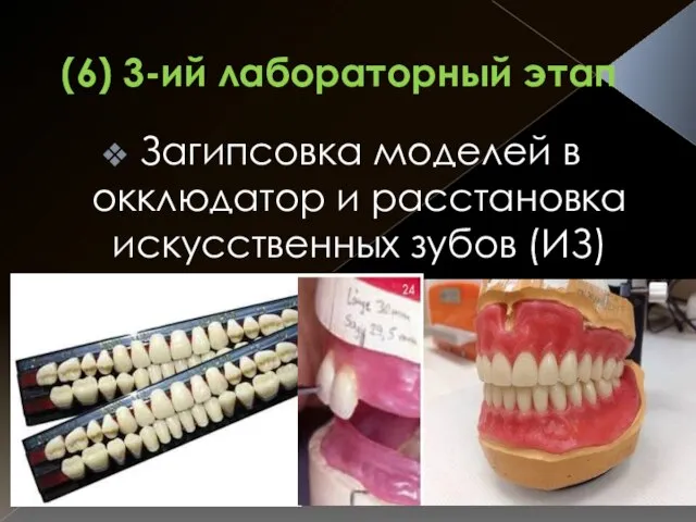 (6) 3-ий лабораторный этап Загипсовка моделей в окклюдатор и расстановка искусственных зубов (ИЗ)