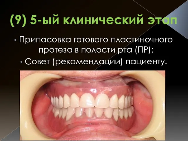 (9) 5-ый клинический этап Припасовка готового пластиночного протеза в полости рта (ПР); Совет (рекомендации) пациенту.