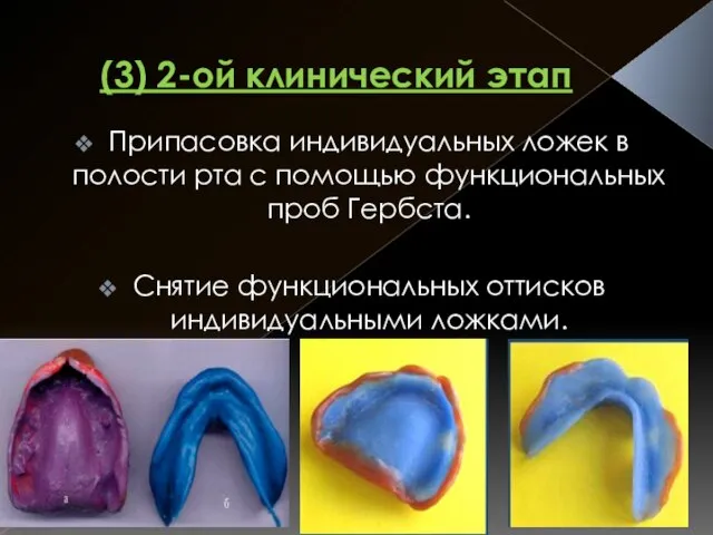 (3) 2-ой клинический этап Припасовка индивидуальных ложек в полости рта с