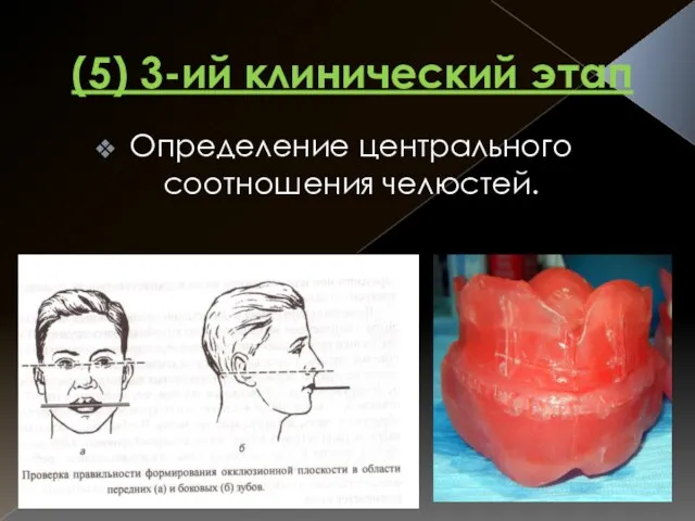 (5) 3-ий клинический этап Определение центрального соотношения челюстей.