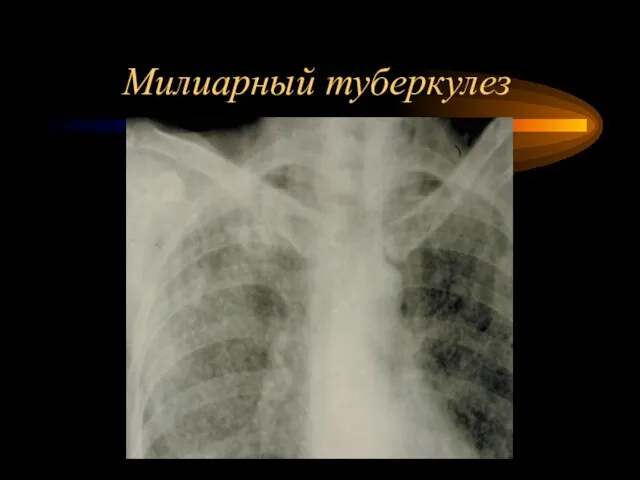 Милиарный туберкулез