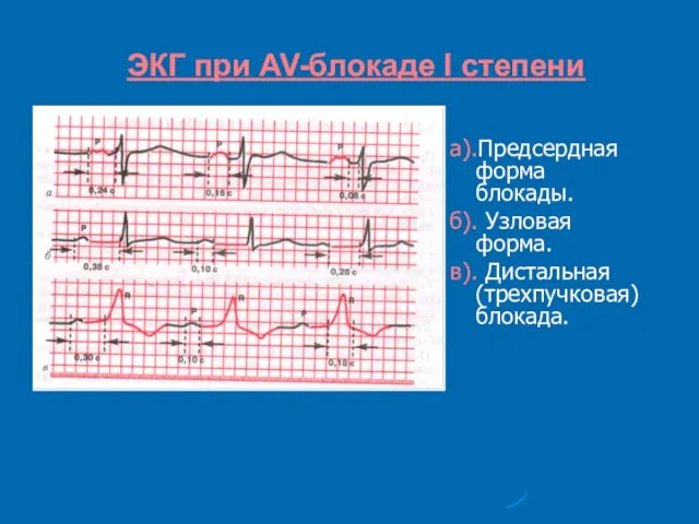 ЭКГ при AV-блокаде I степени а).Предсердная форма блокады. б). Узловая форма. в). Дистальная (трехпучковая) блокада.